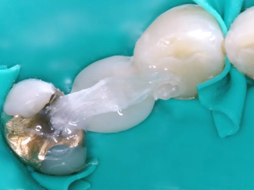 Dentapreg® PFU