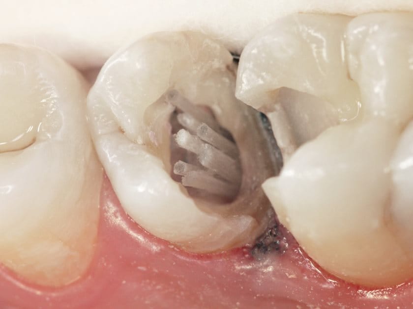 Dentapreg® PINPOST