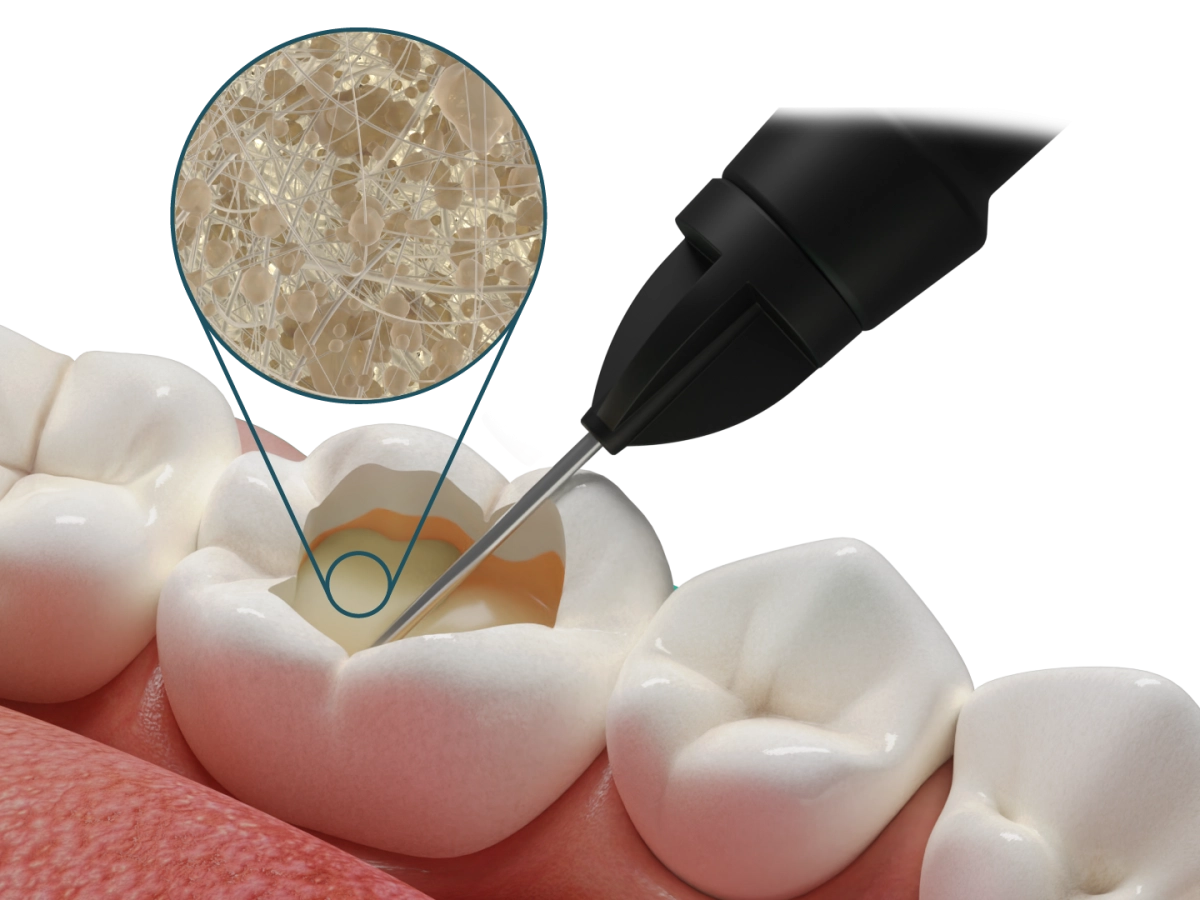 Fibrafill® FLOW
